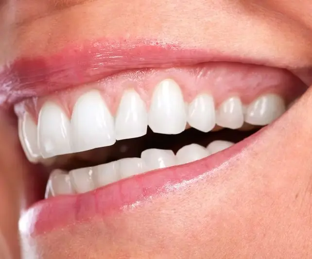 Gengivoplastia em Campo Grande MS